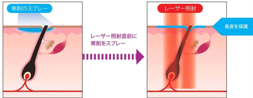 痛みを軽減させる冷却機能